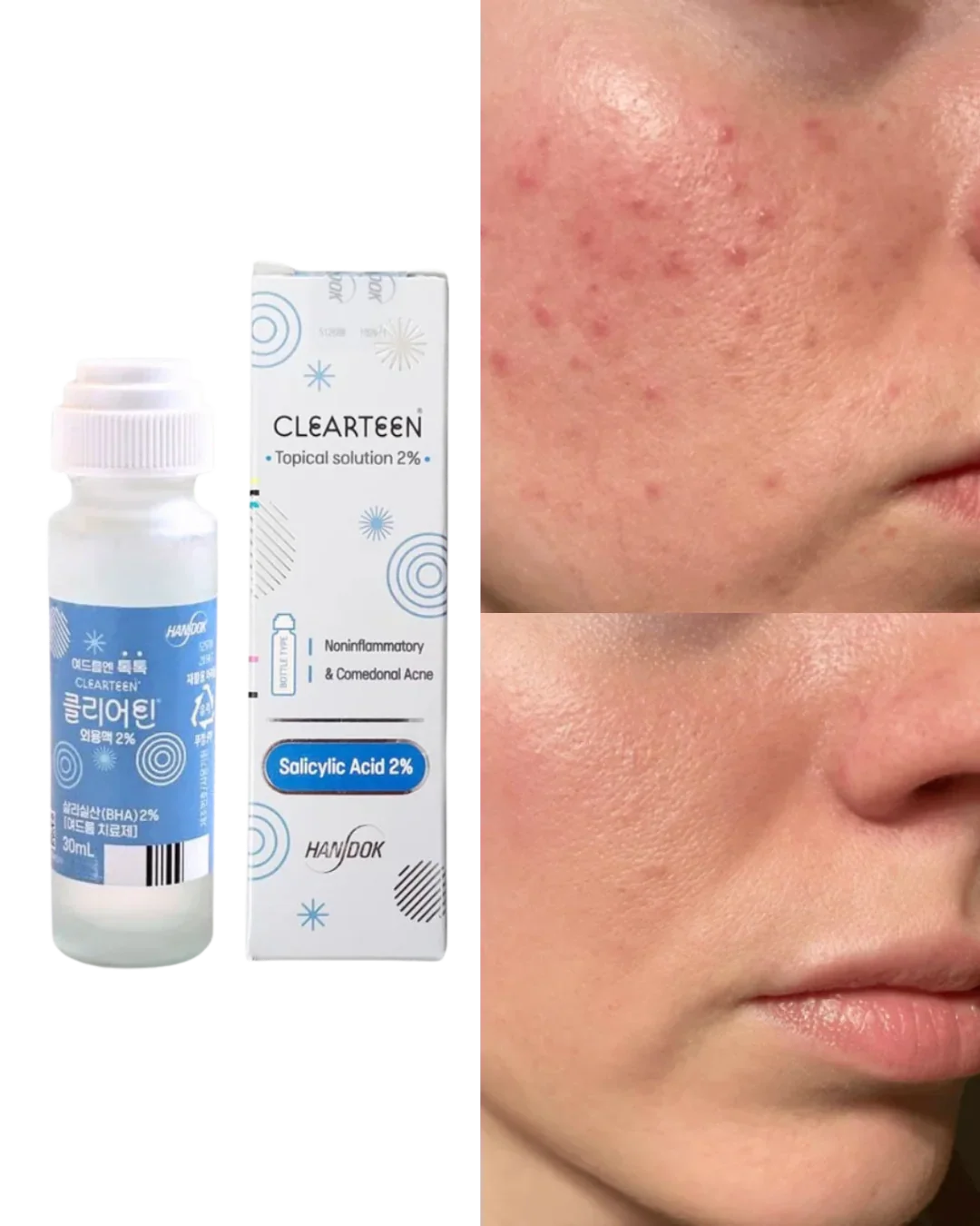 Handok Clearteen Korean Acne Solution Treatment 30ml (2% Salicylic Acid)
