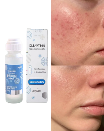 Handok Clearteen Korean Acne Solution Treatment 30ml (2% Salicylic Acid)